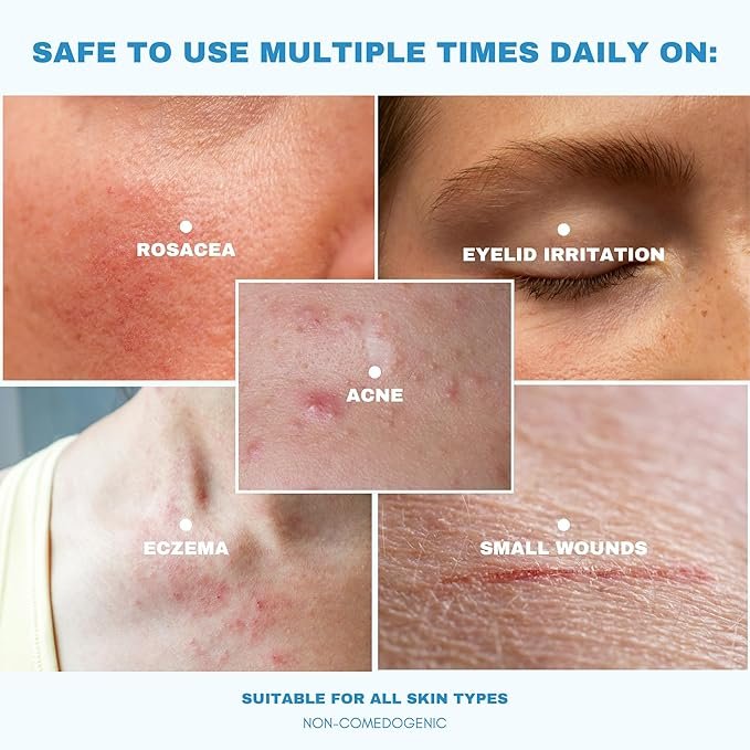 Hypochlorous Acid Spray: Top 5 Solution Of Acne 2 Hypochlorous Acid Spray